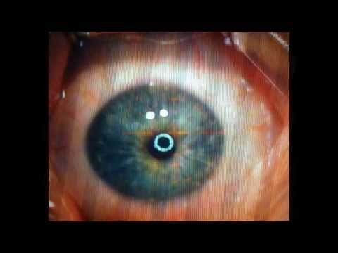 epi-lasik-to-correct-myopia;-second-eye,-august-7,-2009