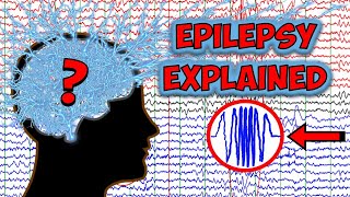 Epilepsy Explained by a Neuroscientist screenshot 4