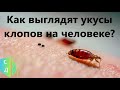 Как выглядят укусы клопов на человеке.