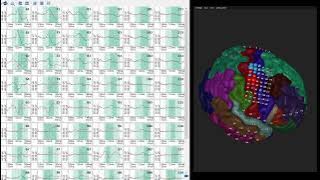 Somatosensory Evoked Potentials (SSEP) recorded in g.HIsys Professional Software