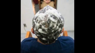 発毛 育毛 デンサーヘアーを８ヶ月使用した実例を追ってみました。東京 原宿 原宿美容室 yippee