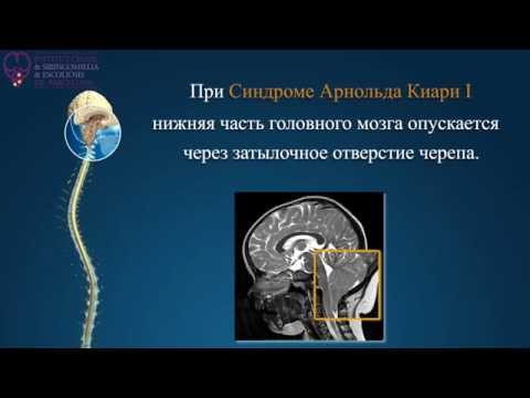 Video: Arnold-Chiarijeva Anomalija - Zdravljenje, Operacija, Simptomi