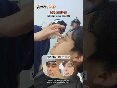 남자코재수술 낮은코+복코+휜코교정 1주차 부목제거 후기 👃