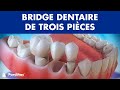 Bridge dentaire de trois pièces ©