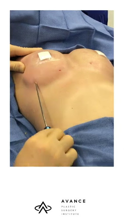 Reno Breast Fat Transfer | Fat Grafting Breast Augmentation Lake Tahoe | Plastic Surgery Institute