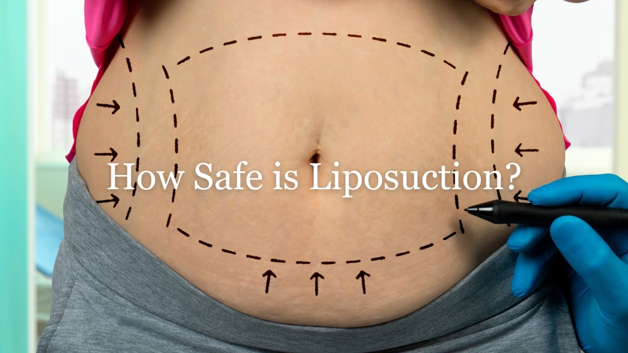 Liposuction Risks How Safe Is Liposuction? | Dr. Stile Breaks It Down - YouTube