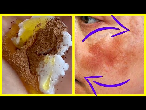 Rub YOUR FACE With CINNAMON FOR 3 Minutes, ERASE FACIAL BLEMISH ! CINNAMON MASK !