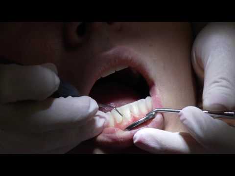 Video: Vyresnių žmonių, Išskyrus Dantų Sveikatos Priežiūros Specialistus, Burnos Sveikatos įvertinimo Savybės: Sisteminė Apžvalga