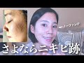 【ニキビ跡治療】大幅に改善した軌跡を全て紹介します