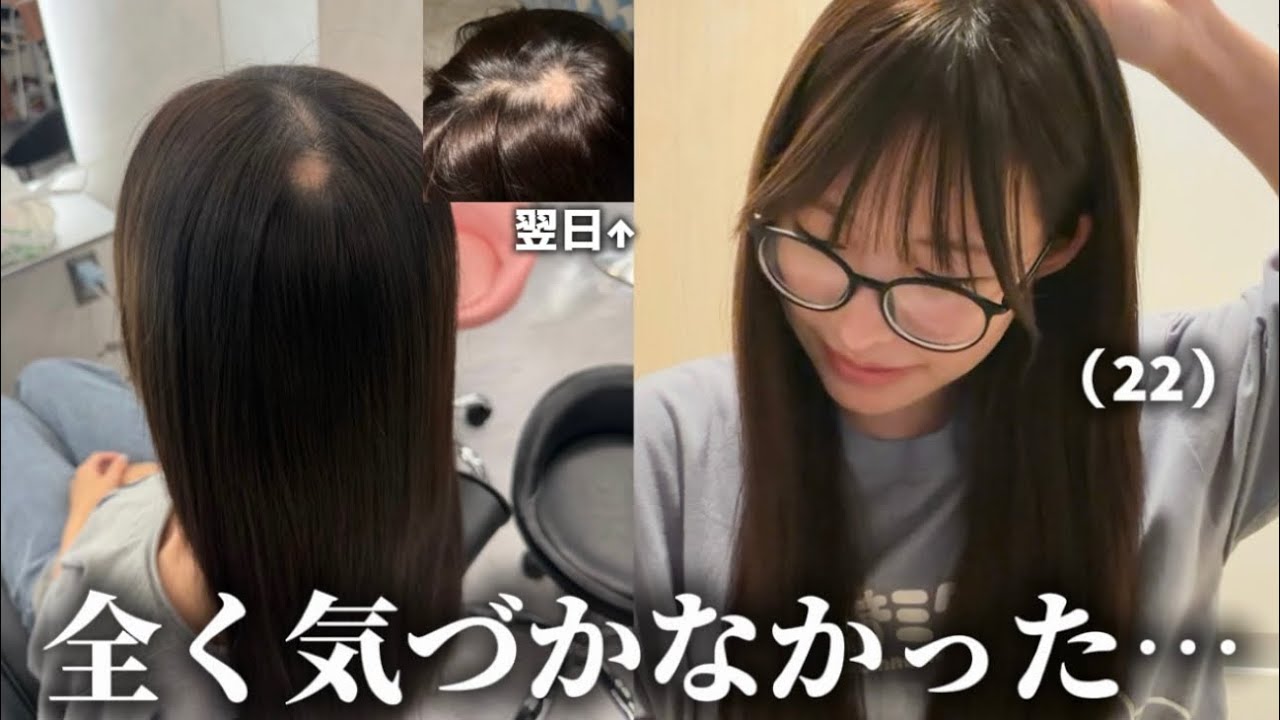 22歳、円形脱毛症になりました