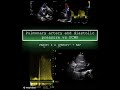Pulmonary artery end diastolic pressure vs pulmonary capillary wedge pressure (PCWP)