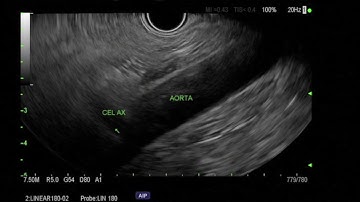 EUS Guided Celiac Plexus Neurolysis