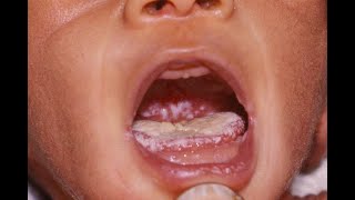 Madaauu Afaanii Fangasiin Dhufu Oral Candidiasis