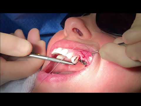 Implant Placement in the Edentulous #12, #13 Area