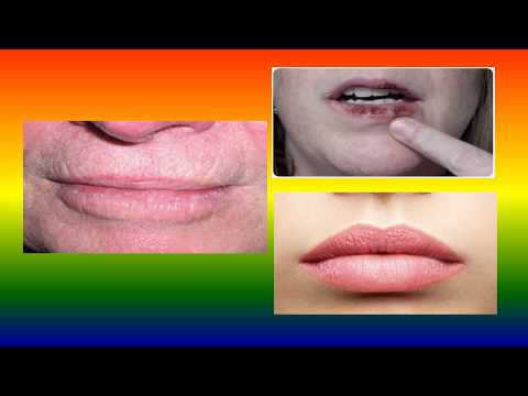 Video: Actinic Cheilitis: Příznaky, Léčba, Prevence A Další