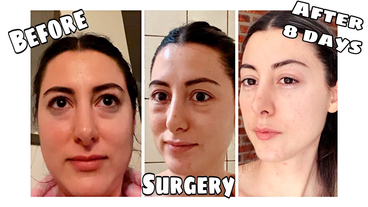 blefaroplastia operacion de papados YouTube blefaroplastia operacion de papados YouTube