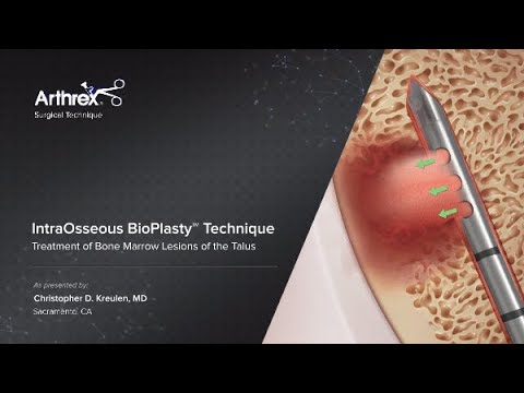IntraOsseous BioPlasty™ Technique Treatment of Bone Marrow Lesions of the Talus