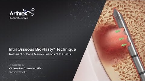 IntraOsseous BioPlasty™ Technique Treatment of Bone Marrow Lesions of the Talus