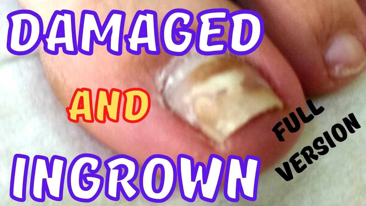 Damaged and ingrown toenail treatment. YouTube