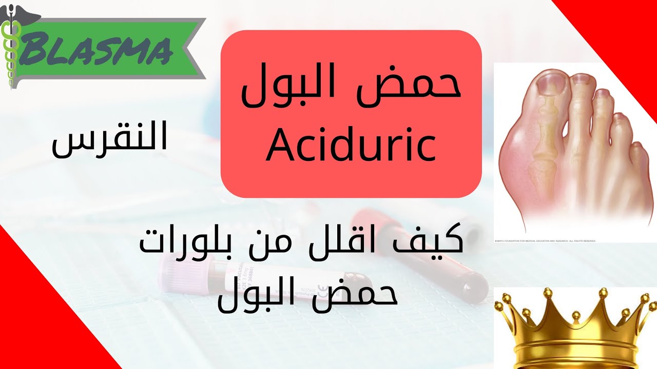 فحص حمض اليوريك او (حمض البول ) ماهو النقرس...كيف اقلل حمض البول..