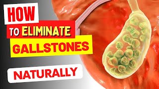 HOW TO ELIMINATE GALLSTONES - NATURALLY (and Avoid Them!)