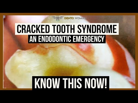 Video: Watter sindrome word geassosieer met botallige tande?