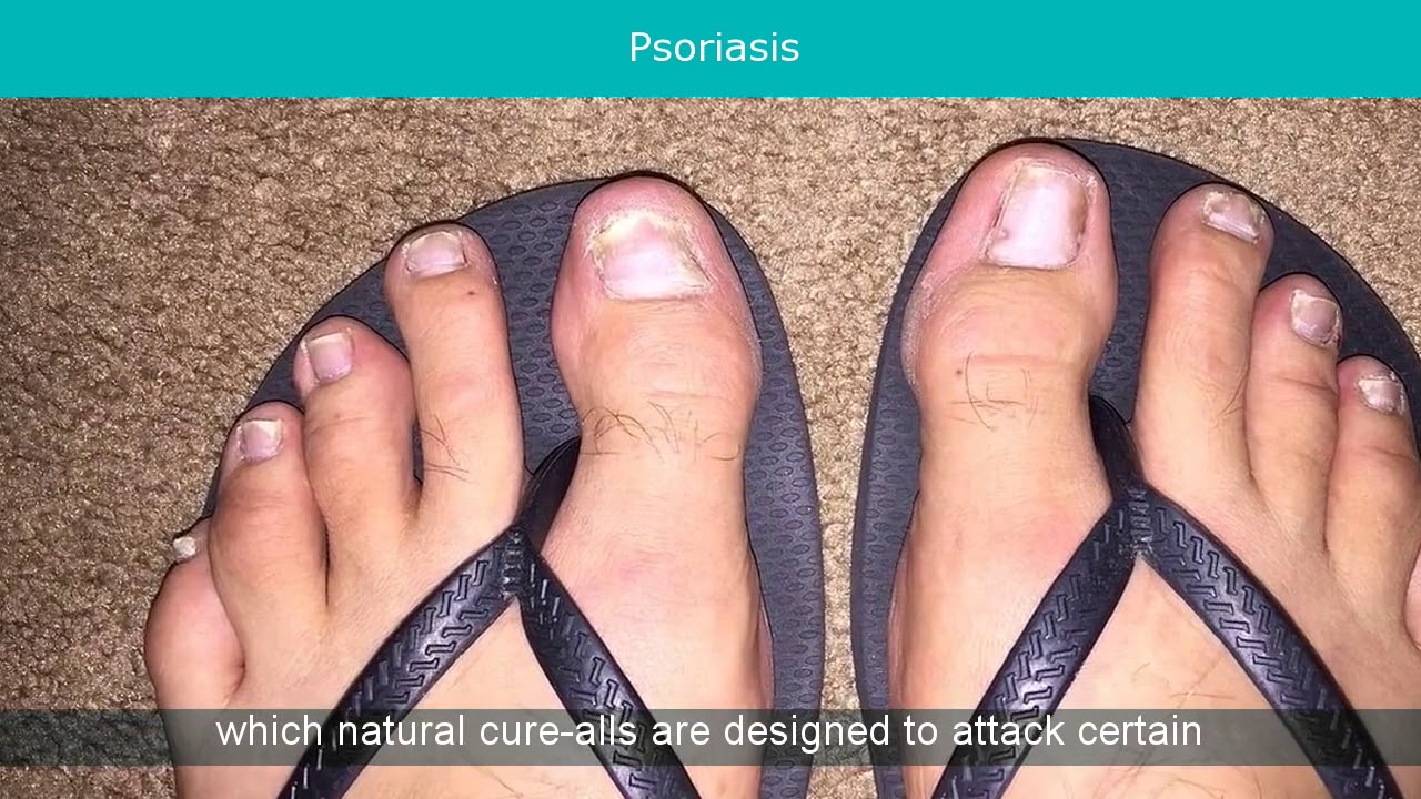 Psoriasis Eyes Cure YouTube