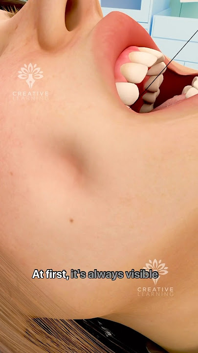 How Dimple Surgery Works 😲#short #dimpleplasty - Creativelearning3d