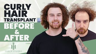 Zachary's Stunning Transformation: A Year After Hair Transplant with Hair of Istanbul
