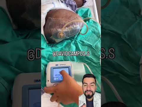 TERAPIA VAC #piediabético