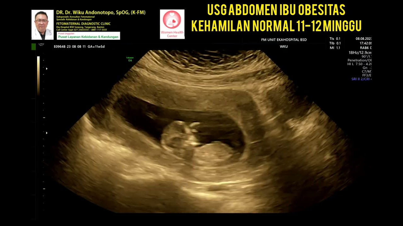 USG ABDOMEN 11-12 minggu pada ibu obesitas