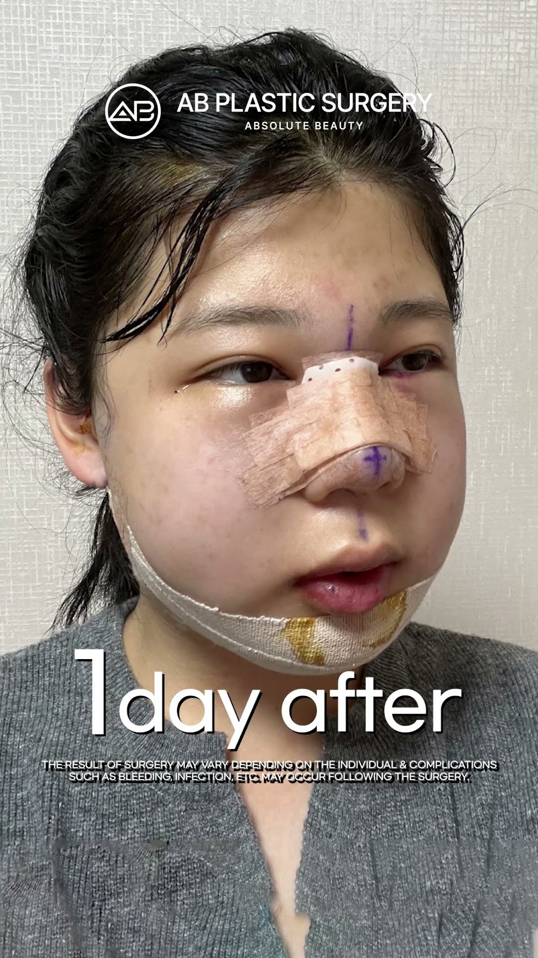 [Plastic Surgery in Korea] Facial Contouring 3-set & Rhinoplasty #abplasticsurgery