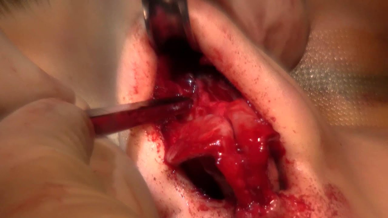 Blunt Osteotomy Rhinoplasty by Dr. Miller