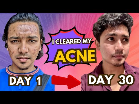 I Cleared My Acne Only In 30 Days | Cleaned My Pimple In 1 Month Only # ...