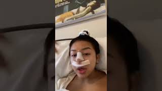 NOSE JOB TRANSFORMATION AT 17