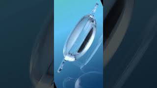 iol yani intraocular lens Jo motiyabind ke surgery ke dauran aankhon mein lagaya jata hai