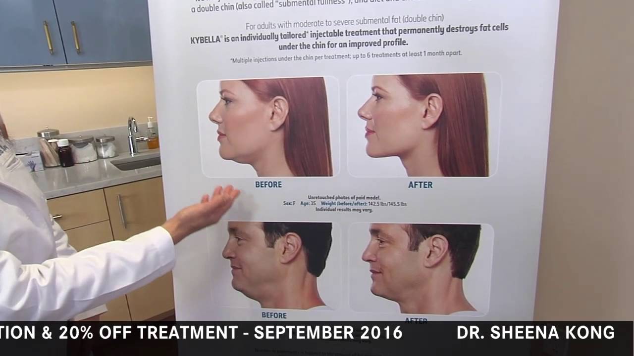 What is Kybella? How does it get rid of a double chin