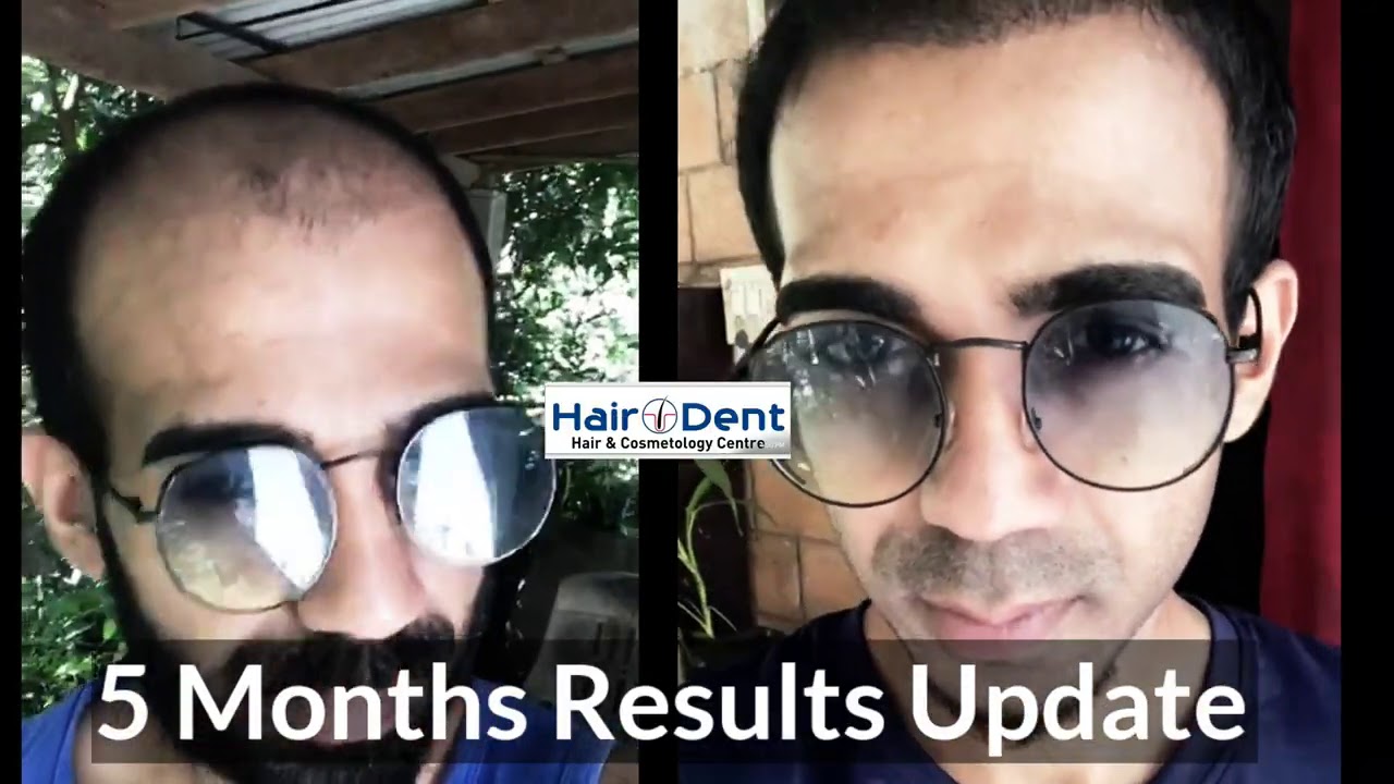 Hair O Dent in KadavantharaErnakulam  Best Hair Transplant Clinics in  Ernakulam  Justdial