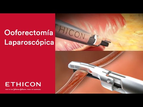 Ooforectomía derecha Video Laparoscopica 