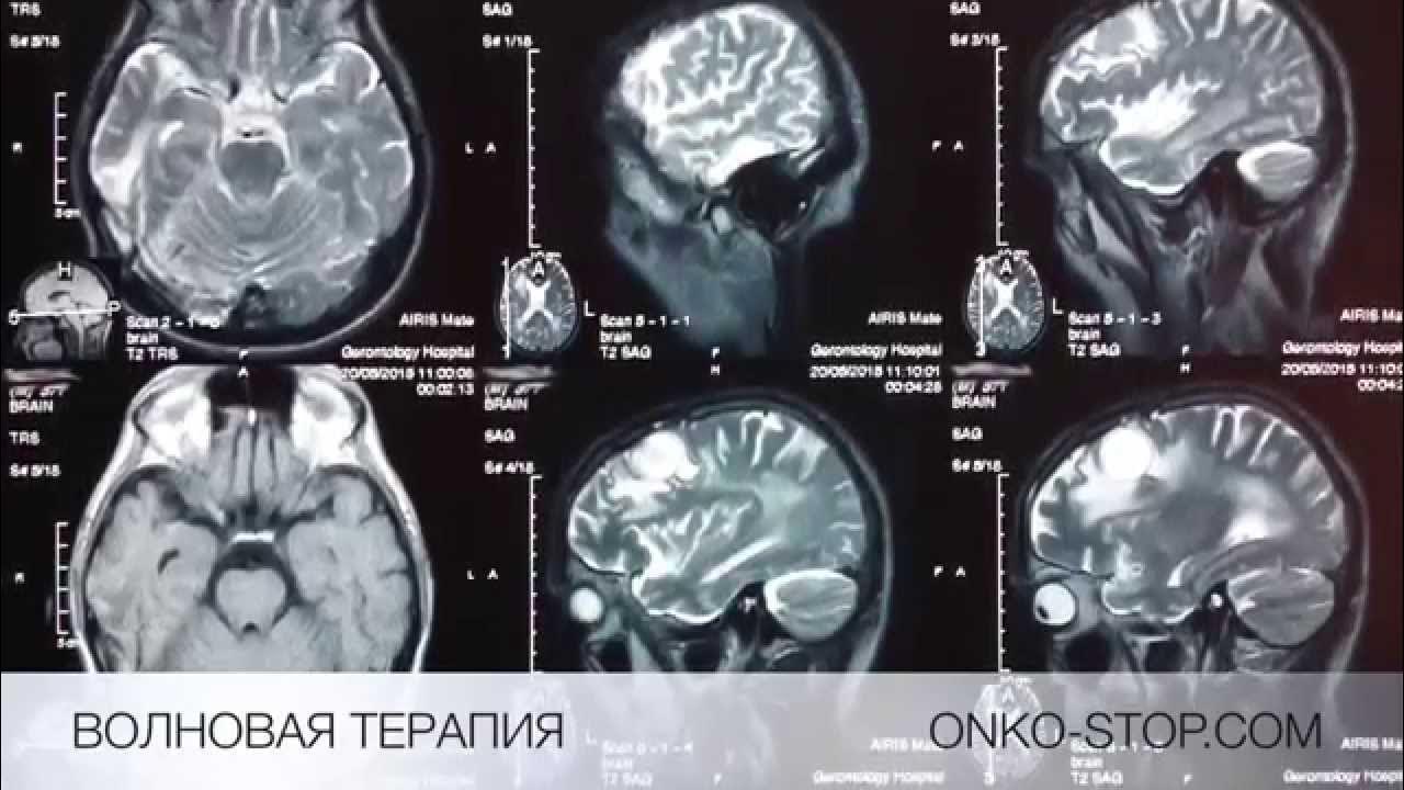 Метастазы в голове и легких. Видео метастазы в голове. онкология 4 стадии голова.