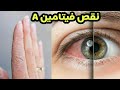 أعراض و علامات نقص فيتامين A نقص فيتامين أ 