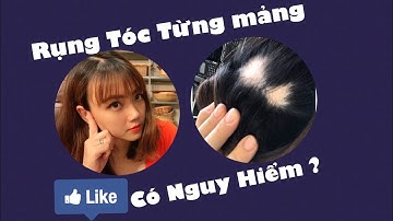 Vlog 9: Rụng tóc từng mảng liệu có nguy hiểm