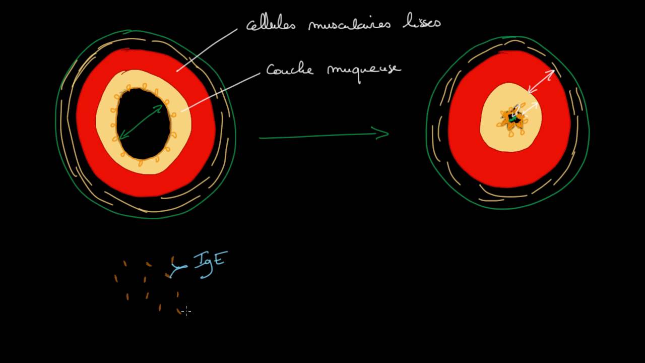 Physiopathologie de l'asthme