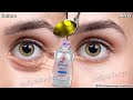 In 3 days Remove Under Eye Bags Completely | Remove Dark Circles, Wrinkles, and Puffy Eyes