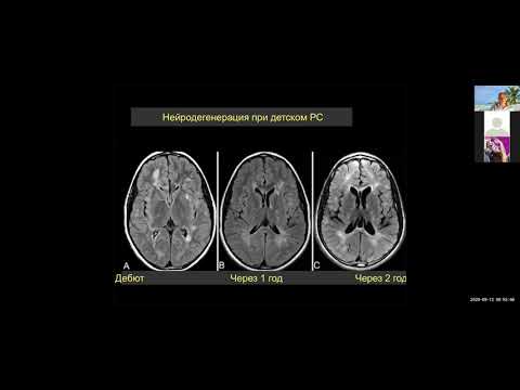 8. Рассеянный склероз / Multiple sclerosis