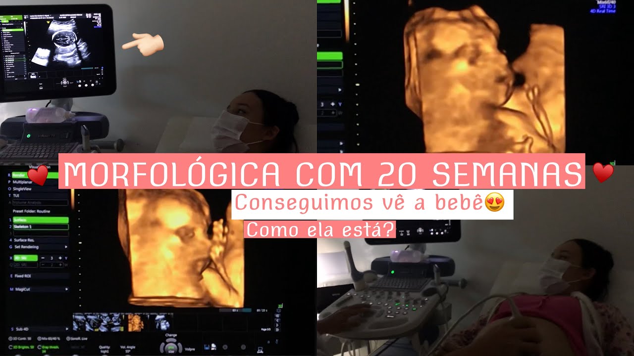 MORFOLÓGICA COM 20 SEMANA DE GESTAÇÃO - Conseguimos vê a bebê 🥰 - YouTube