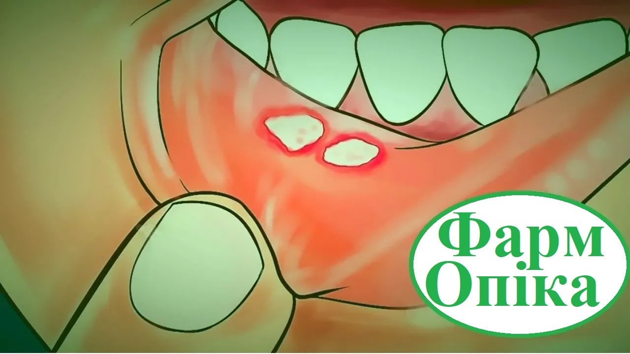 Стоматит. Причини, симптоми, лікування. - YouTube