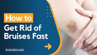 How to Get Rid of Bruises Fast and Easy