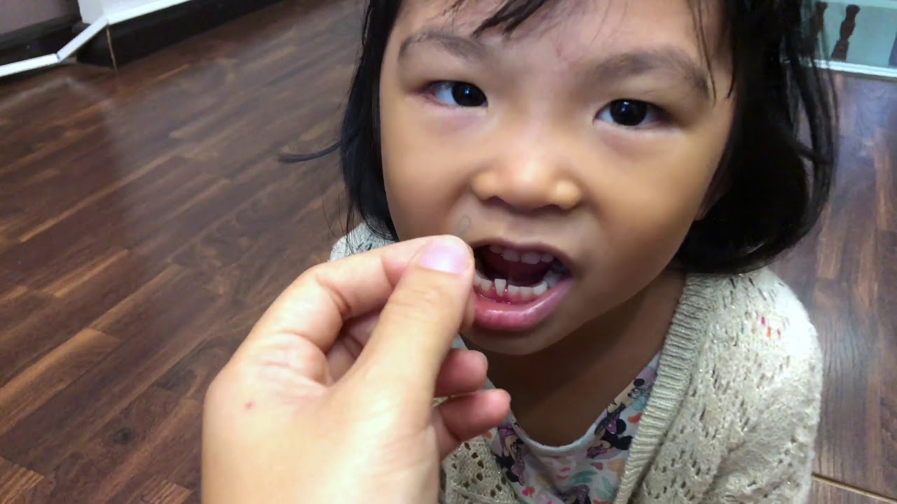 kid tooth extraction 