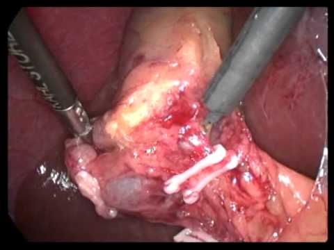 Lap Cholecystectomy Unedited 427  Moderate GB In Previous Upper Abdominal Surg  Case